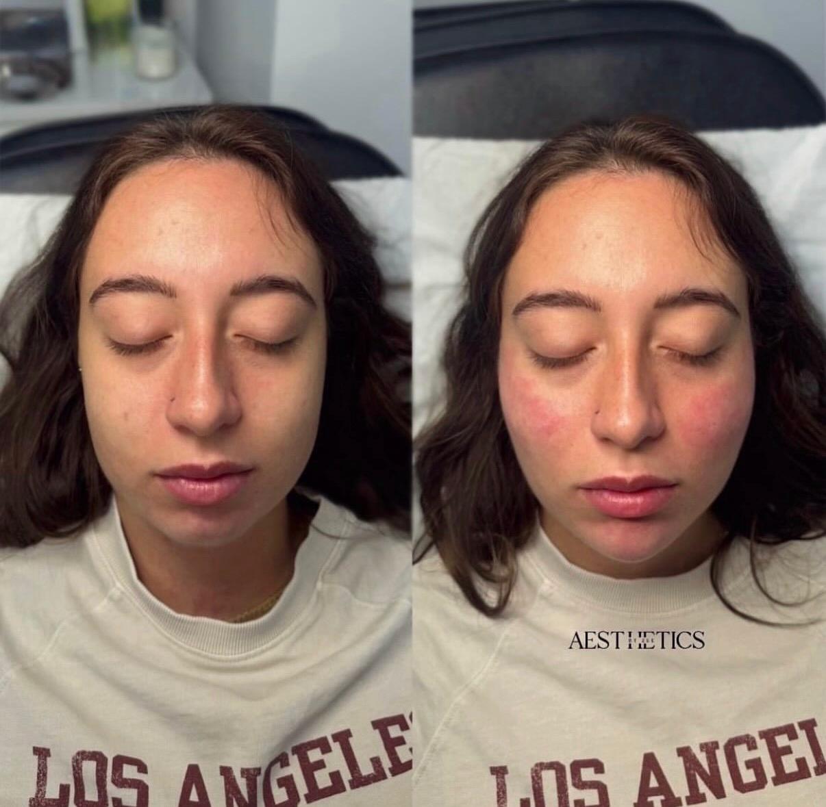 Skin Rejuvenation