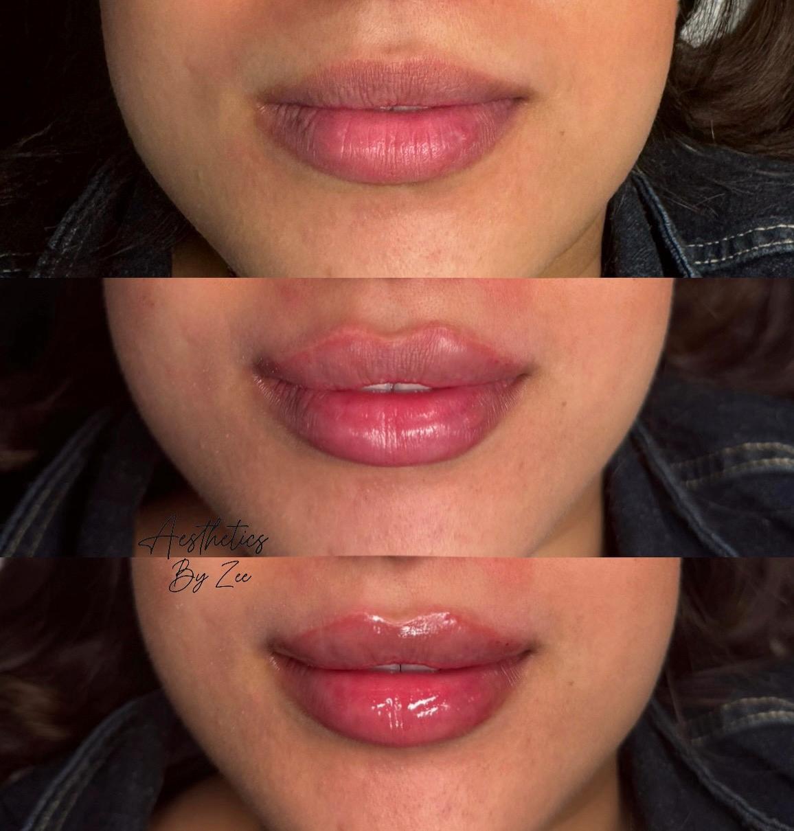 Lip Filler