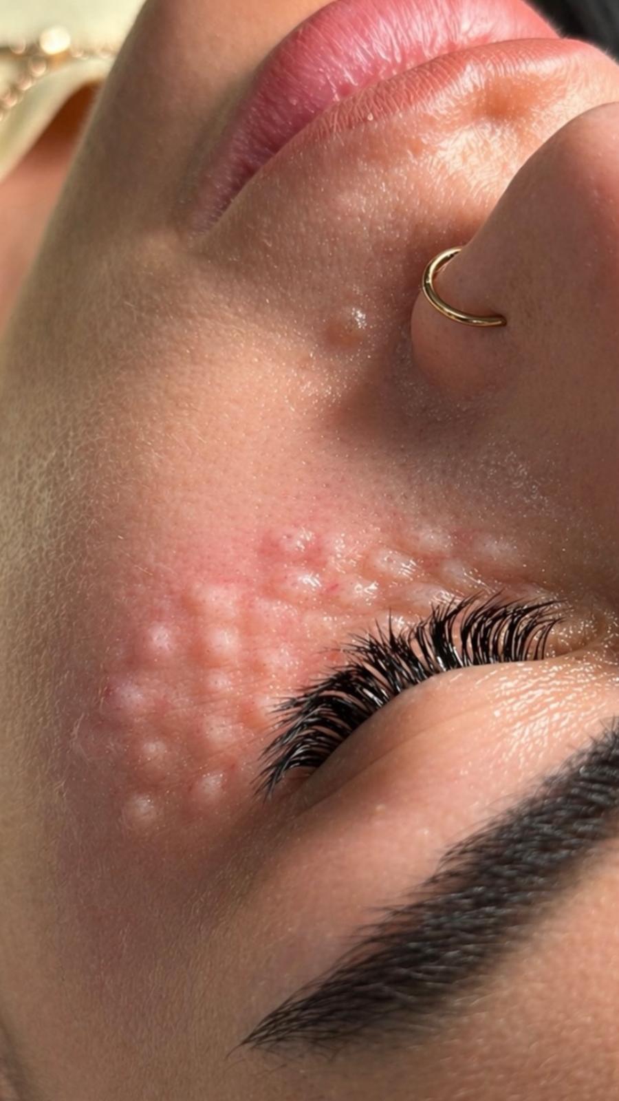 Acne & Skin Concerns