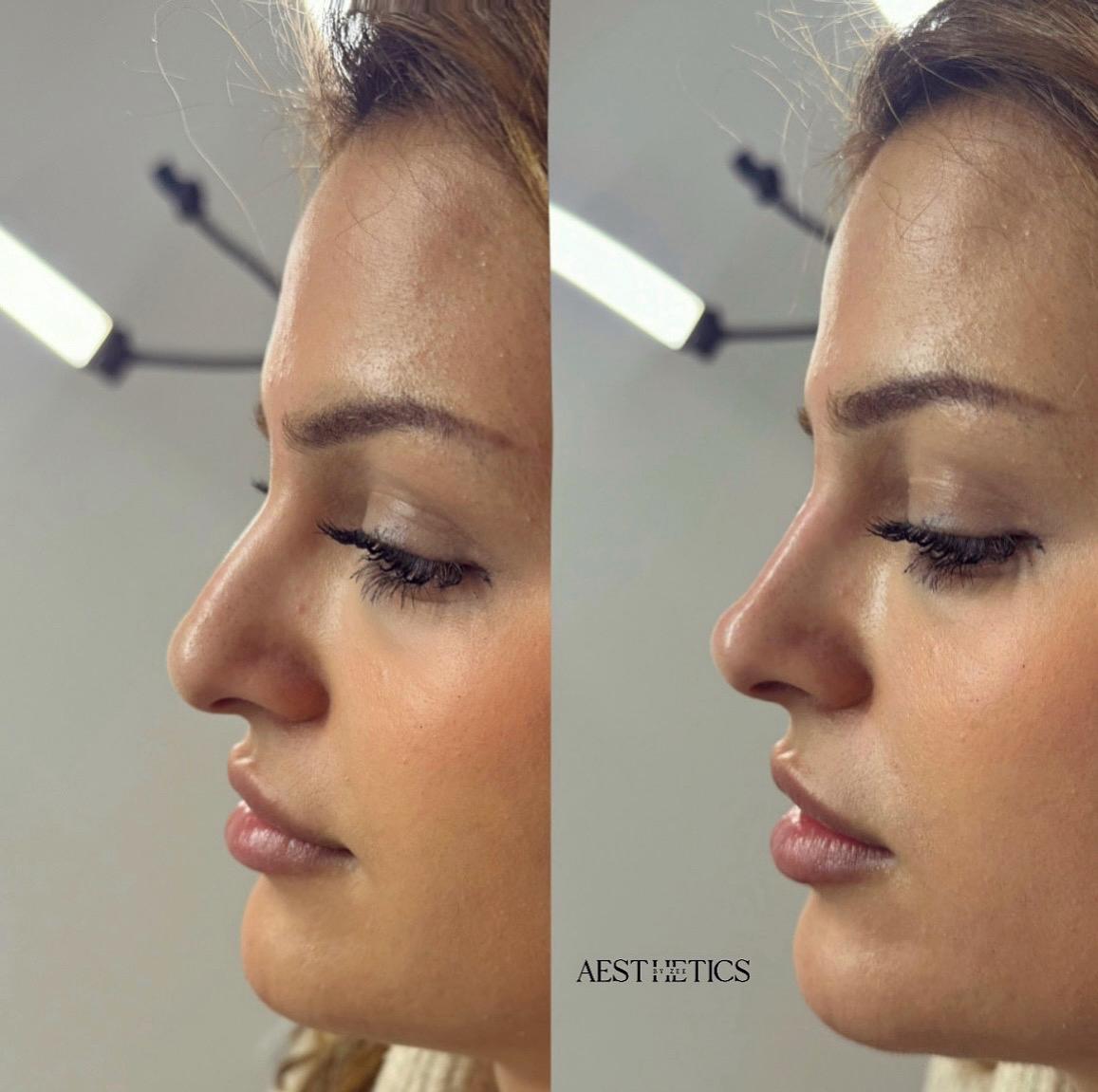 Non-Surgical Rhinoplasty
