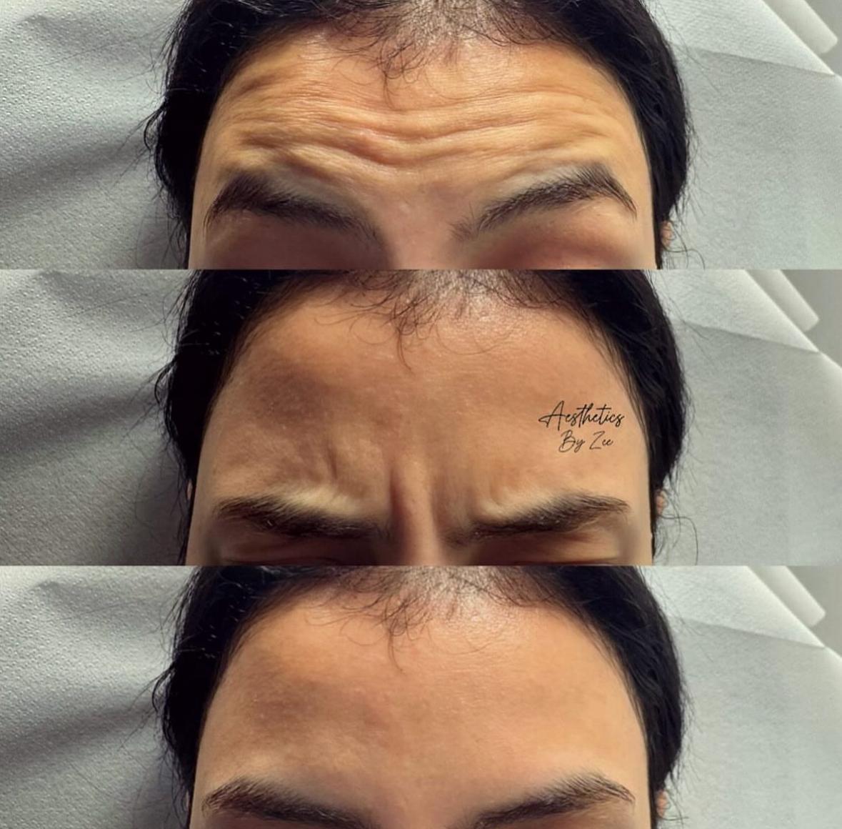 Anti-Wrinkle — Forehead